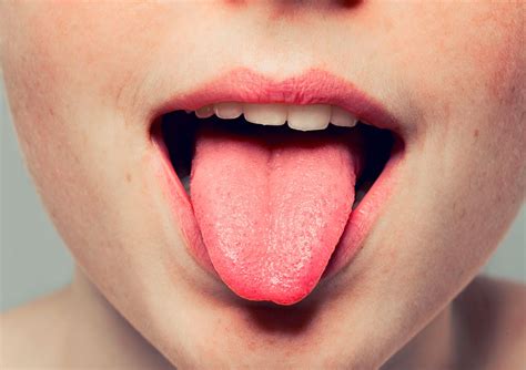doenças da língua-1